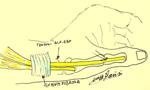 De Quervain 1