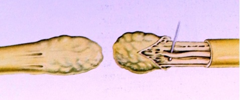 Neuroma - Neurinoma 1