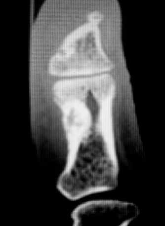 Osteoma osteoide 1