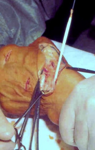 Lesione sottocutanea tendini 1